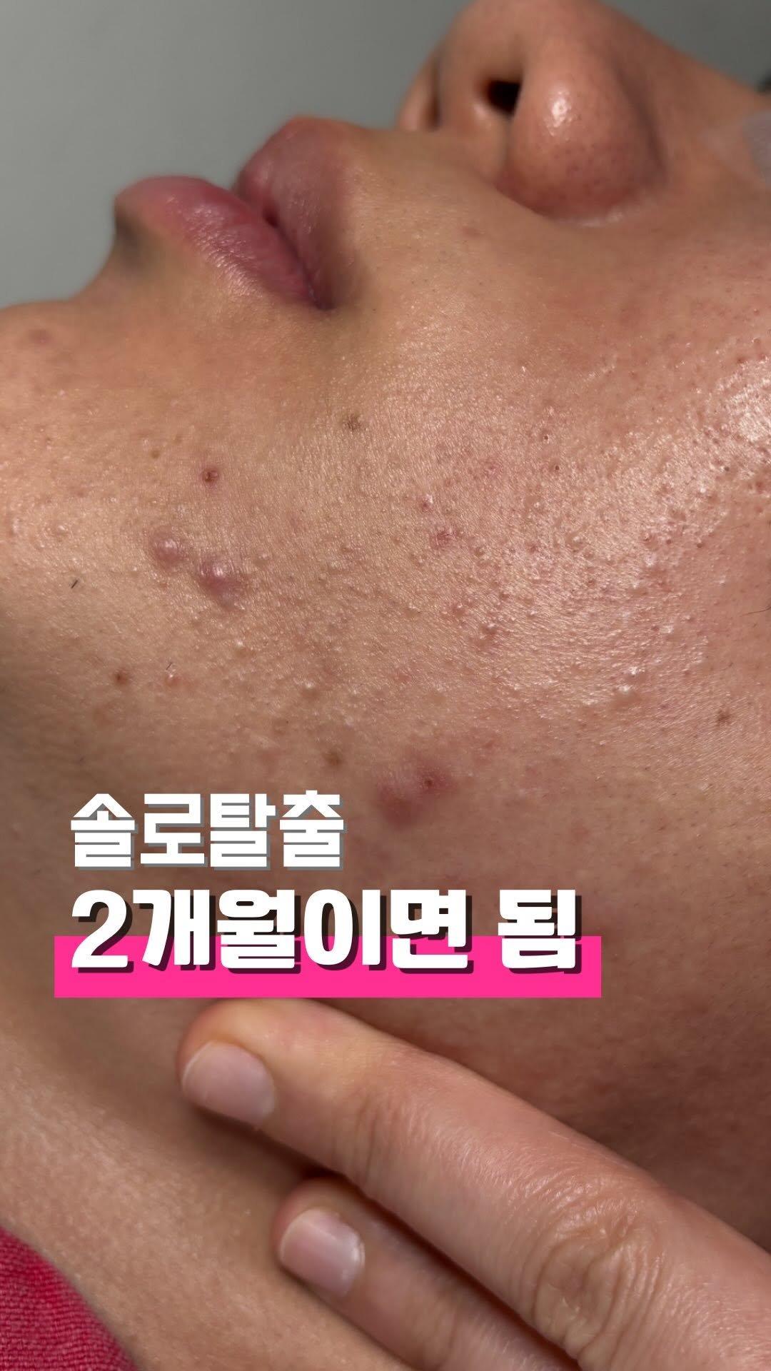 zero_skin 게시물 이미지: 저에게 두 달만 주시요.☺️ 

오래 안 걸림 🥹

#여드름관리만하는곳_제로스킨...