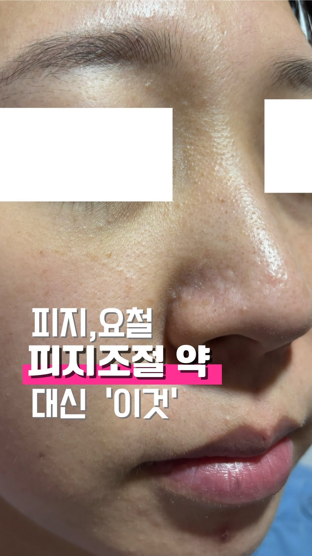 zero_skin 게시물 이미지: 이 조합은 진짜 소리부터 다릅니다.

피지 조절 약 대신,
집에서 안전하게 하는...