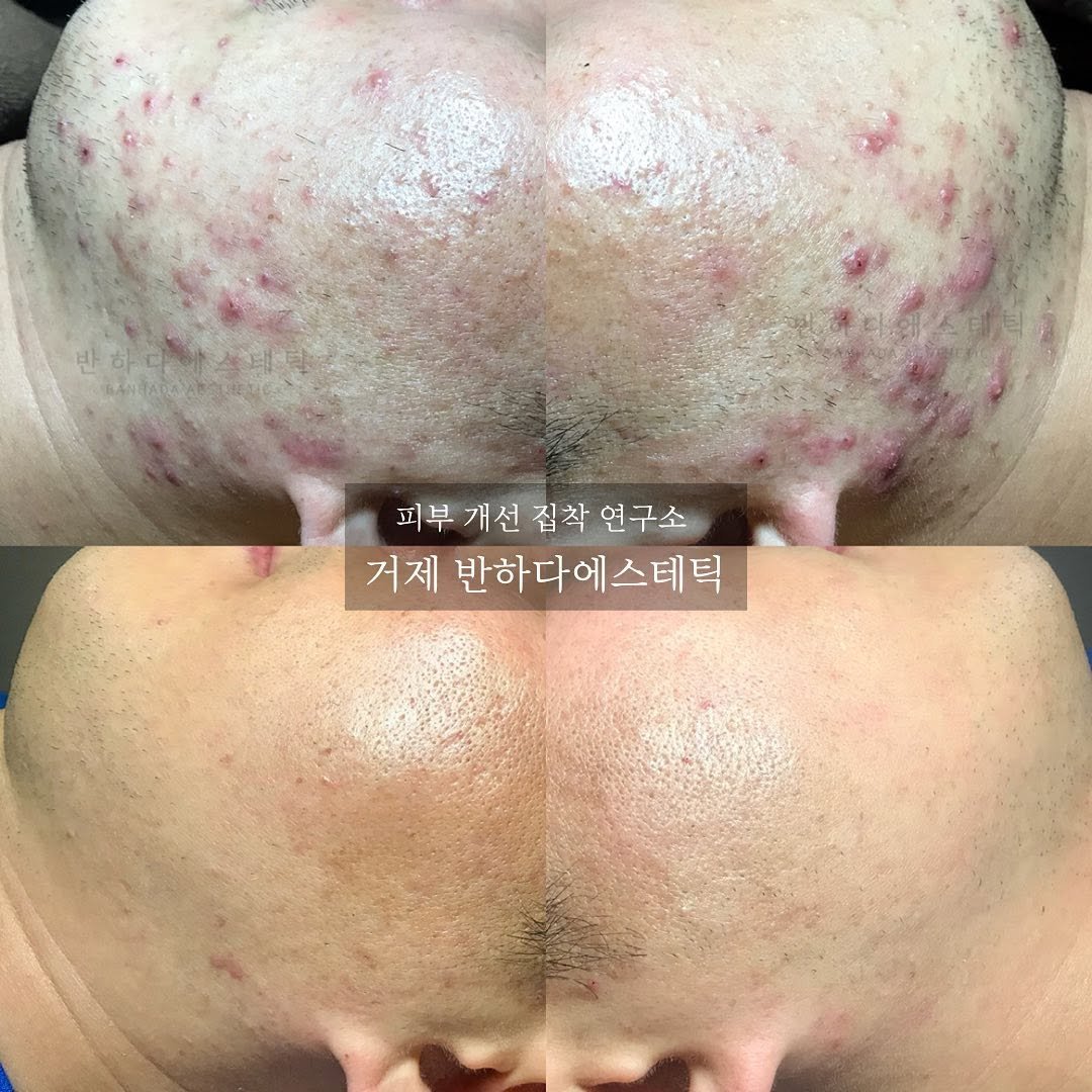 Photo by 대한민국 여드름은 제로스킨/홍대피부관리/아나픈 여드름압출/대표원장 유화영 in Goeje Island, Korea.