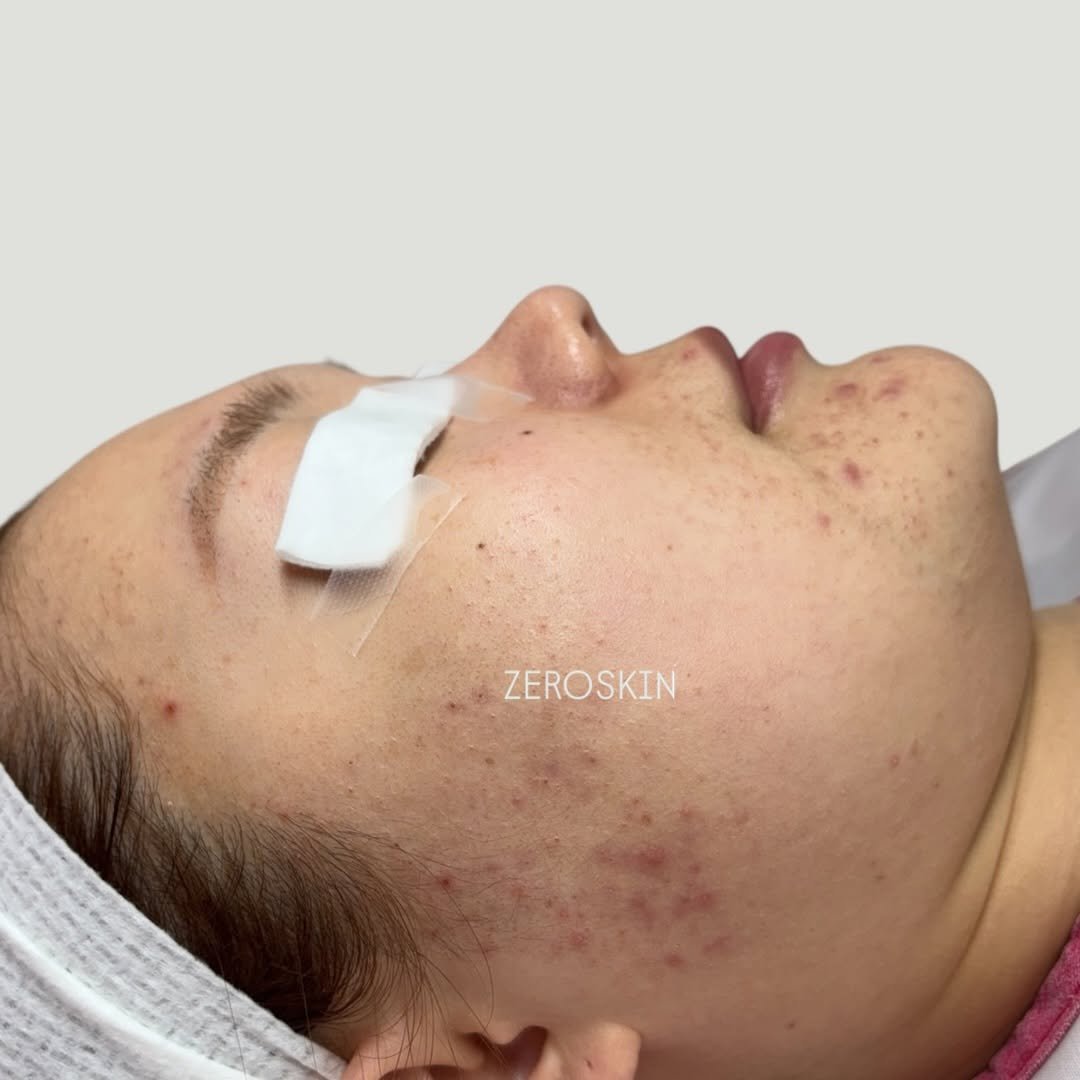 Photo by 대한민국 여드름은 제로스킨/홍대피부관리/아나픈 여드름압출/대표원장 유화영 on January 03, 2026. May be an image of text.