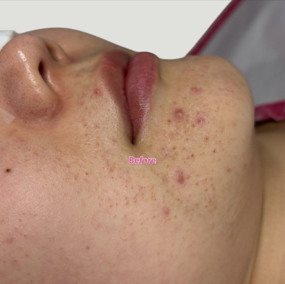 Photo by 대한민국 여드름은 제로스킨/홍대피부관리/아나픈 여드름압출/대표원장 유화영 on November 16, 2025. May be an image of text.