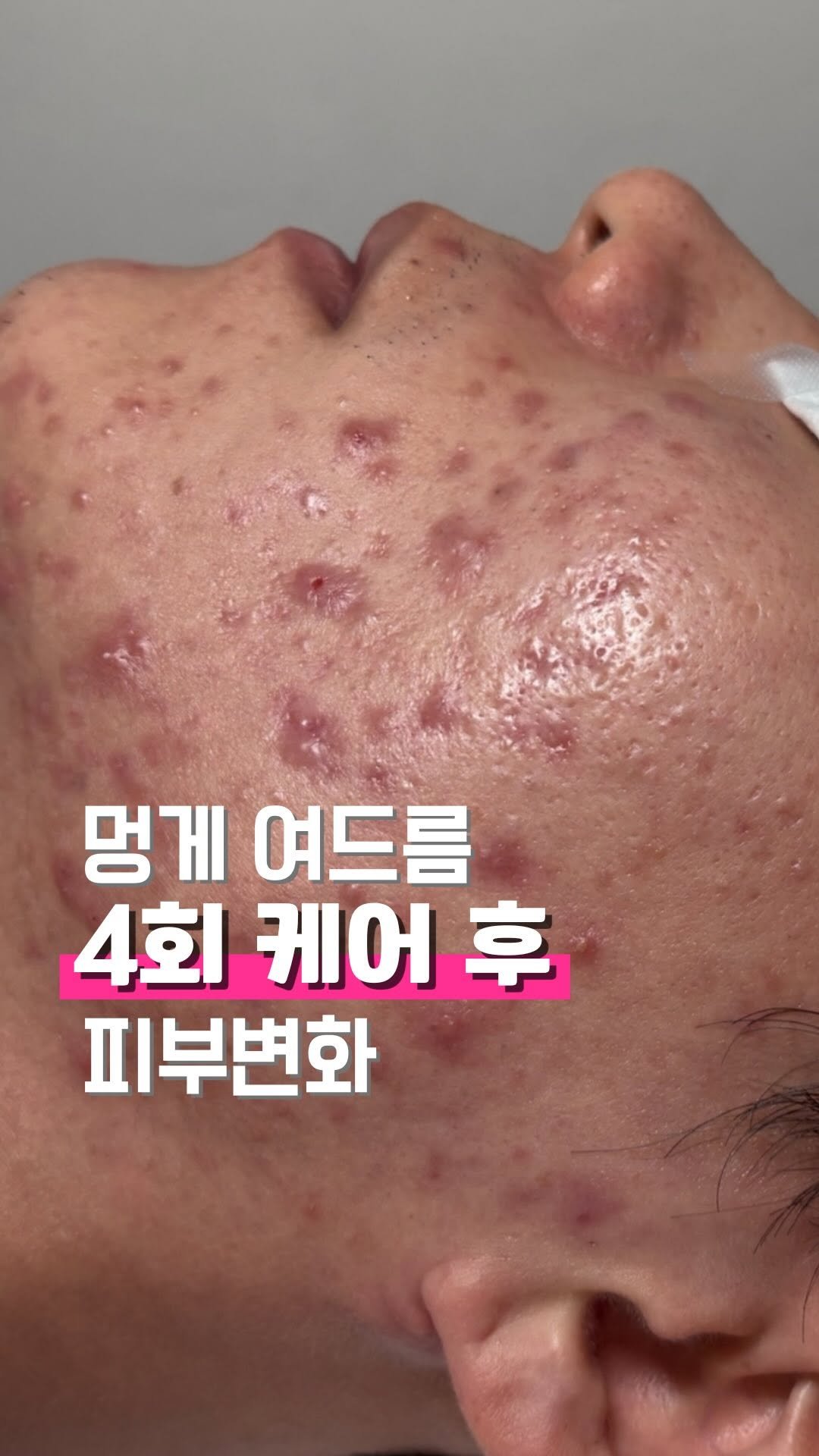 zero_skin 게시물 이미지: 4회만에 이만큼 좋아졌는데..
⠀⠀⠀⠀⠀⠀⠀⠀⠀⠀⠀⠀

앞으로 얼마나 더 좋아질지...