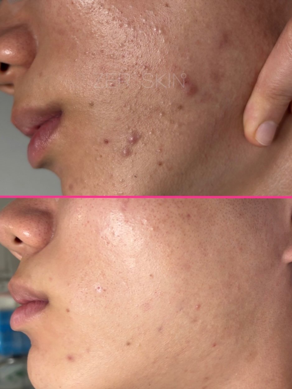 Photo by 대한민국 여드름은 제로스킨/홍대피부관리/아나픈 여드름압출/대표원장 유화영 on February 11, 2026. May be an image of one or more people and text.